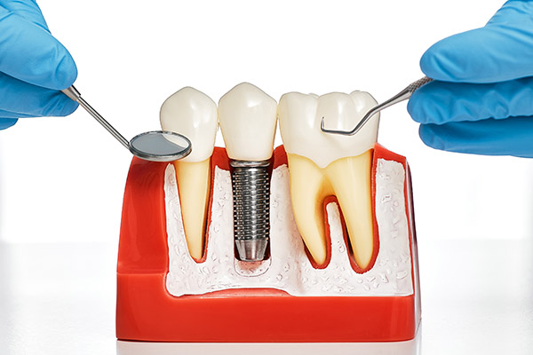 Being Referred To A Periodontist For Implants